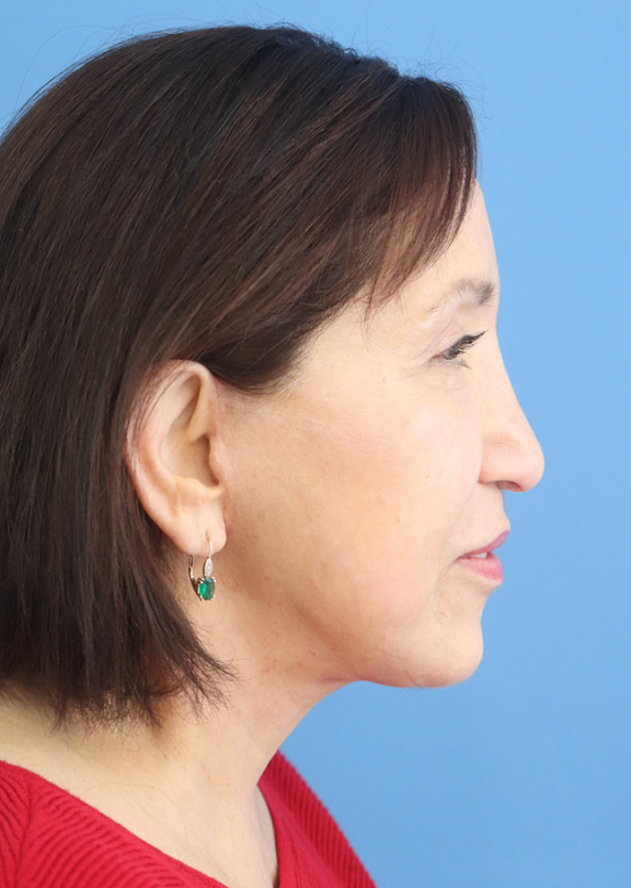 Facelift Before & After Gallery - Patient 418529 - Image 2